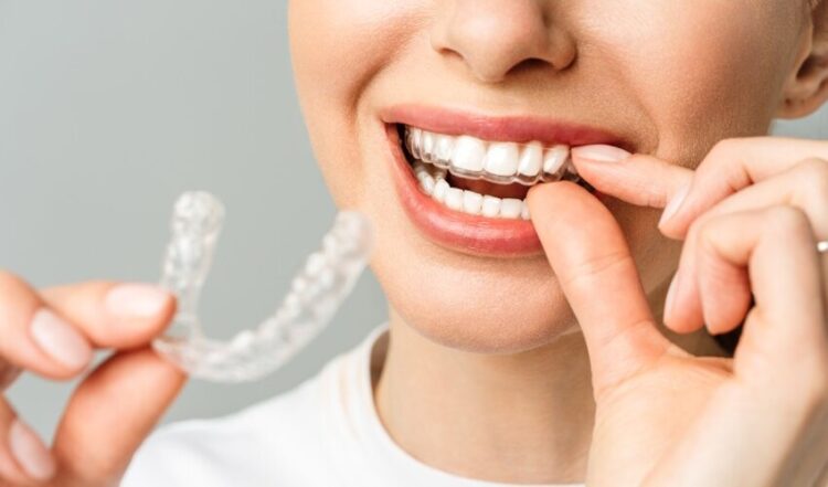 Smile with Aligners